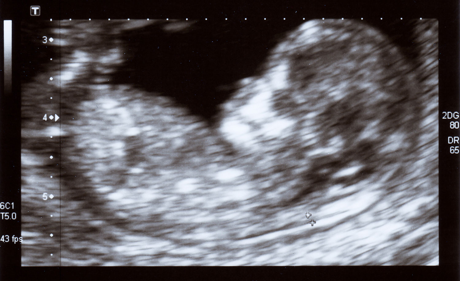 Ultrasound Image of Baby